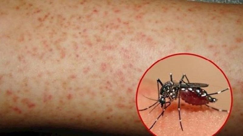 muỗi đốt gây sốt xuất huyết